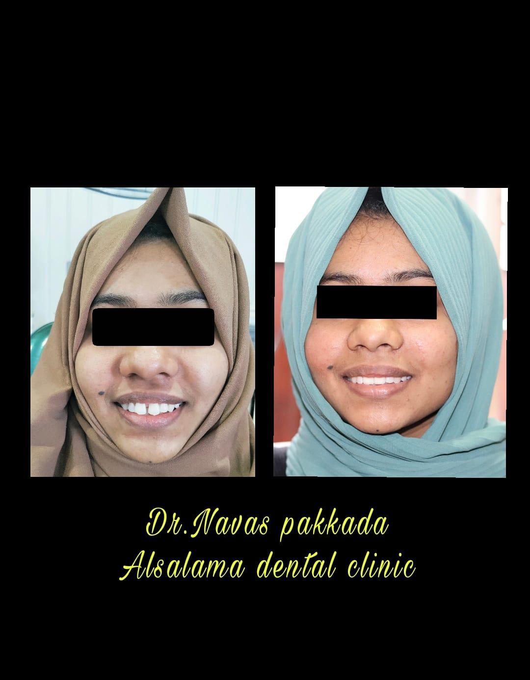 Smile designing